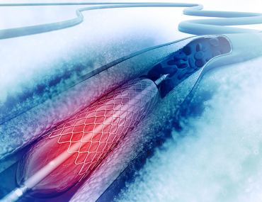 angioplasty stent