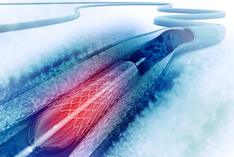 angioplasty stent