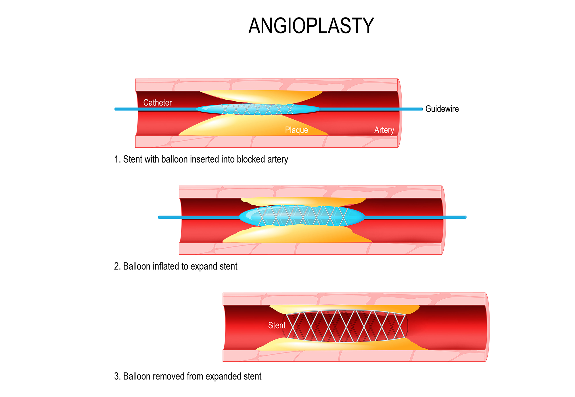 Stent Implantation Coronary Angioplasty Angioplasty And Stent