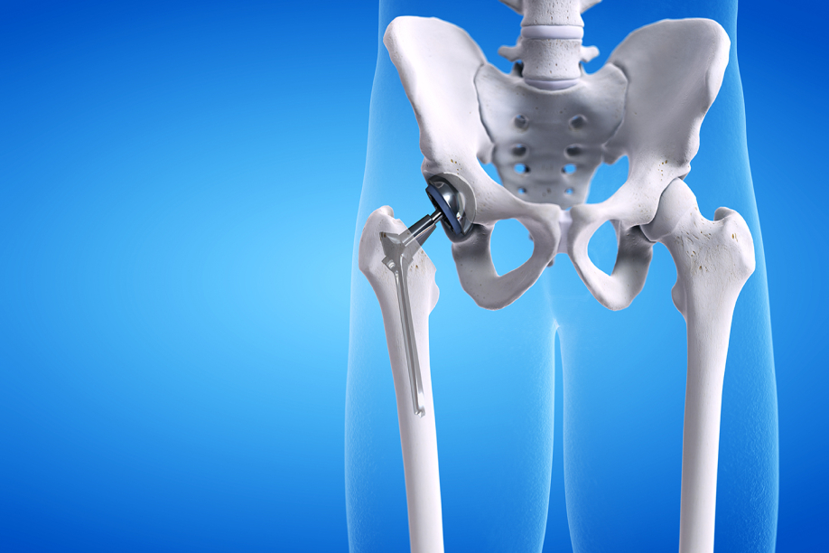 Advantages of Anterior Hip Replacement Surgery | Add More to Life - Meril