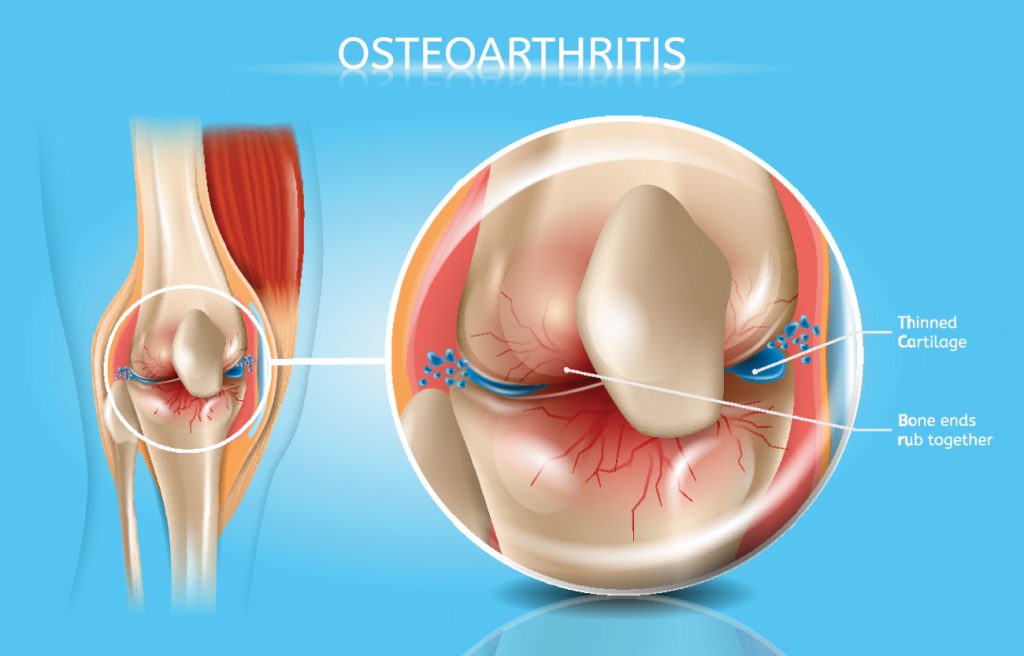 Osteoarthritis