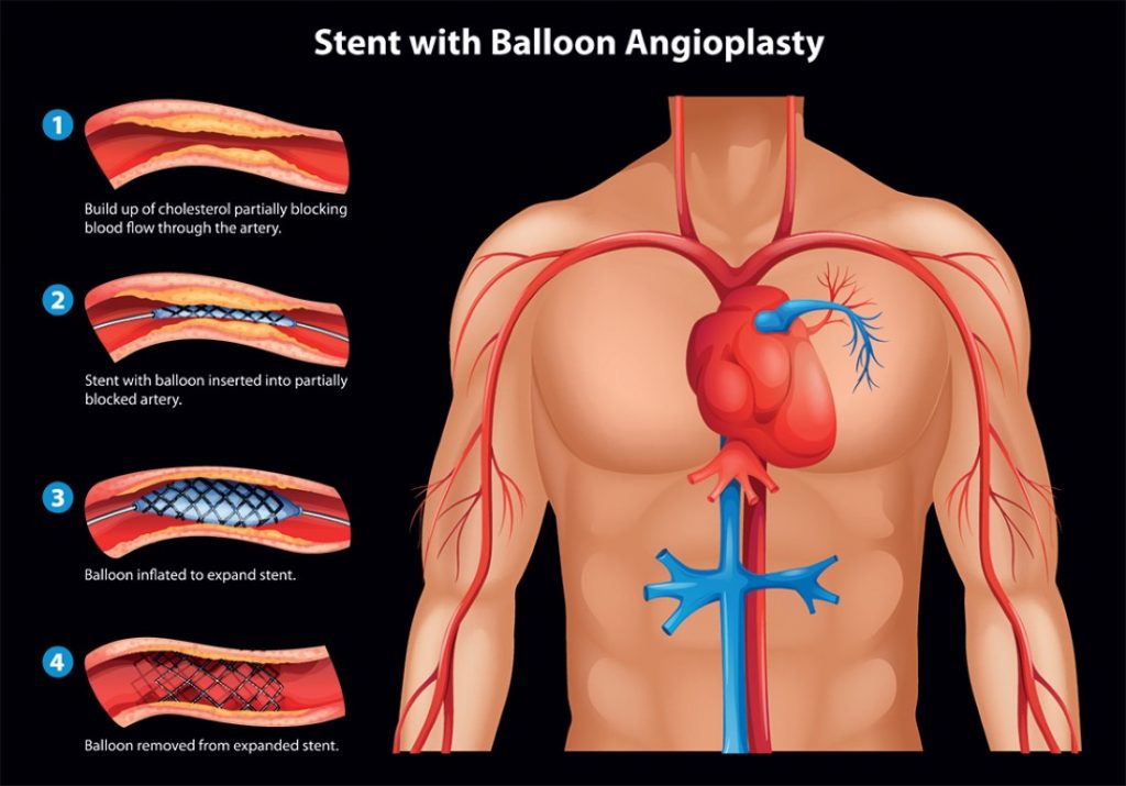 This image has an empty alt attribute; its file name is stents-2-1024x715.jpg