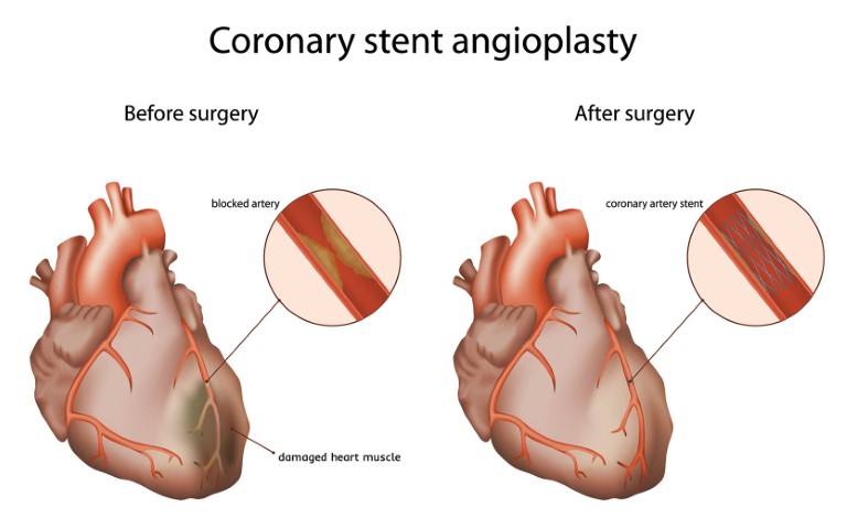 can a person travel after angioplasty
