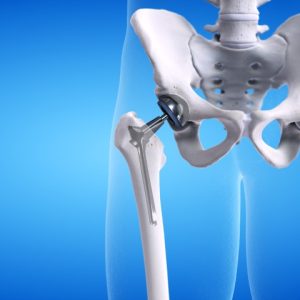 New Techniques For Total Hip Replacement | Advances And Innovations In THA