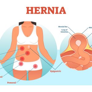What are the Different Types of Hernia?