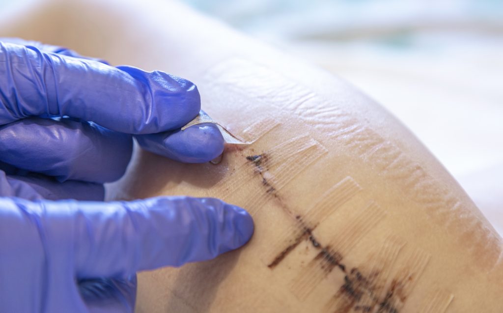 Advantages of Using Antibacterial Sutures in Wound Closure Add More