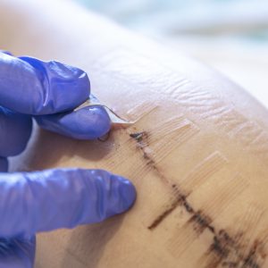 Advantages of Using Antibacterial Sutures in Wound Closure