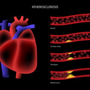 Can Aortic Aneurysm Be Dangerous?