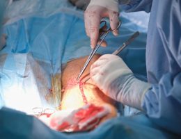 Is it Time for a Knee Replacement? Signs Your Joint Pain May Be Serious