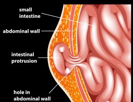 Open vs Laparoscopic Hernia Repair – Understanding the Differences