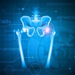 Diet and Hip Osteoarthritis: How Nutrition Can Impact Hip Osteoarthritis