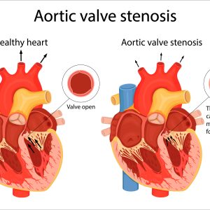 Aortic Stenosis: Understanding a Major Heart Condition