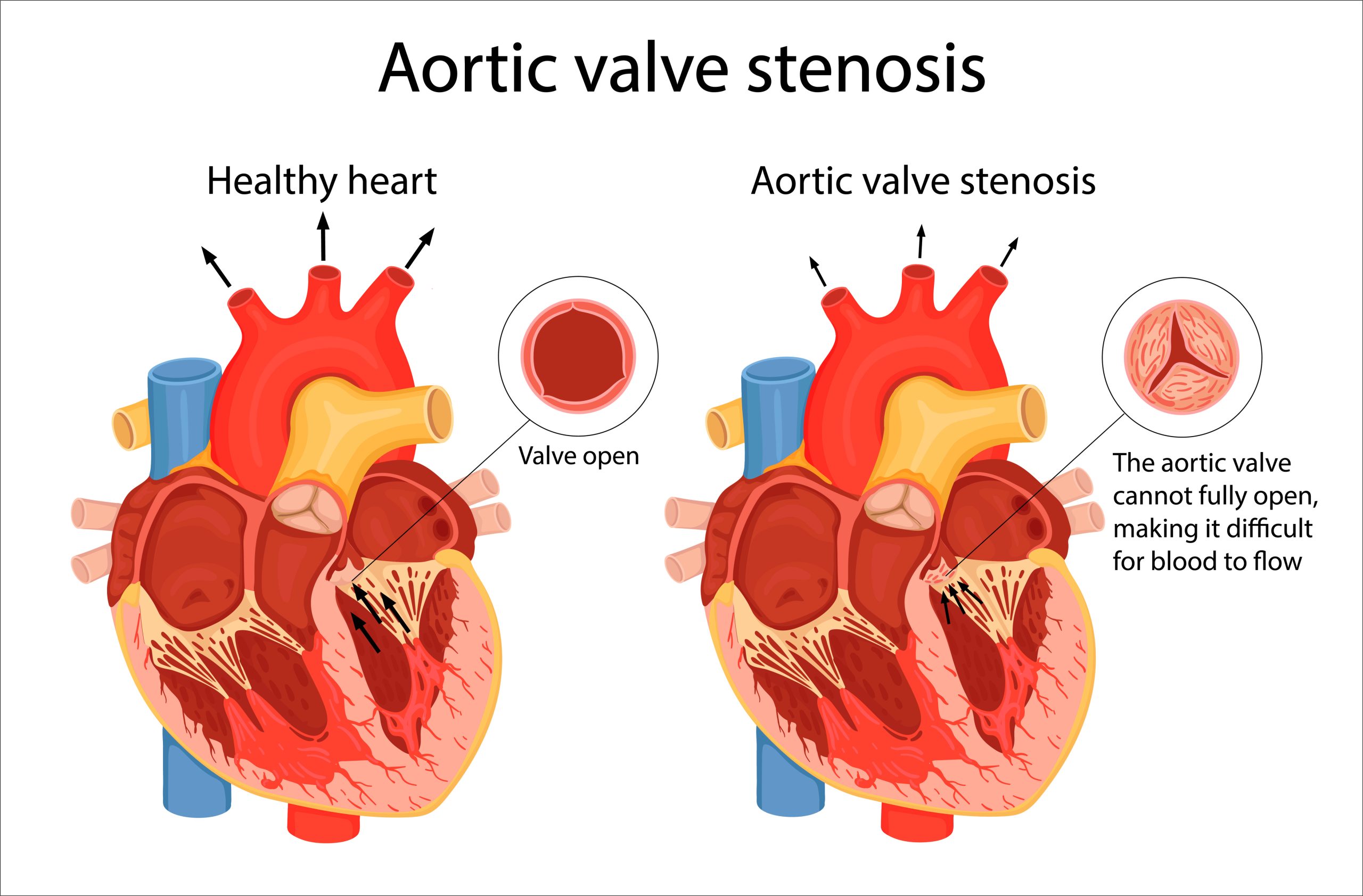 SMART Trial Reaffirms Hemodynamic Superiority of Tavr Self-Expanding Valve in Aortic Stenosis Patients with a Small Annulus Over Time and Regardless of Age