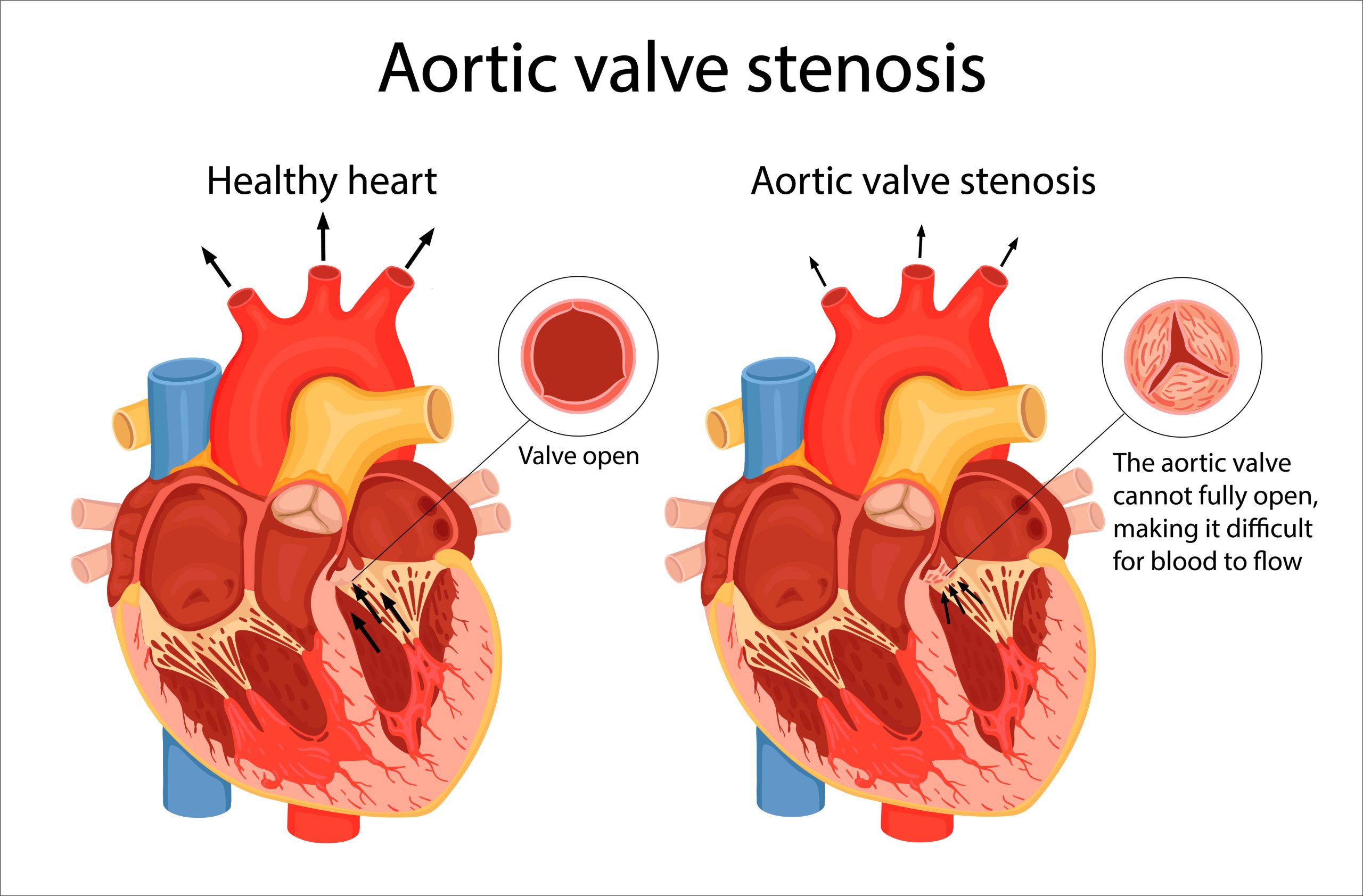 Aortic Stenosis Exploring A Critical Heart Condition Add More To Lives