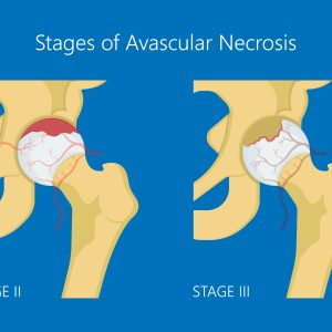Avascular Necrosis: Unlocking the Mystery Behind Silent Bone Decay