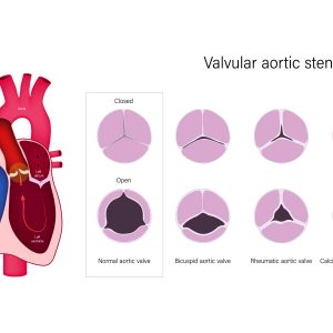 Difference between TAVR and SAVR