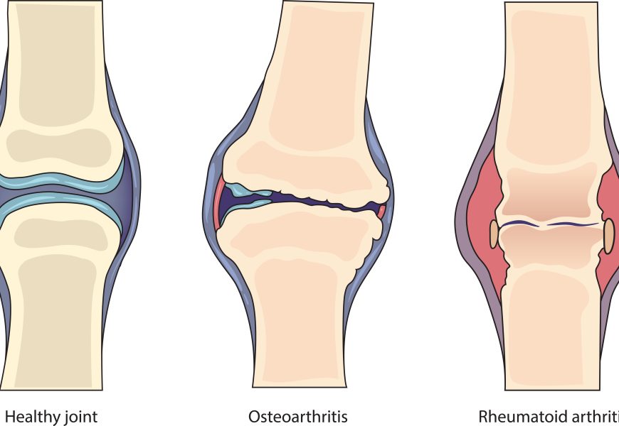 Arthritis Showdown: Unraveling the Differences Between Osteoarthritis and Rheumatoid Arthritis