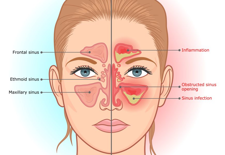 Sinus Infection: Warning Signs And Symptoms