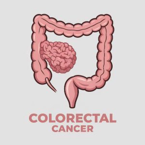 Early Signs and Symptoms of Colorectal Cancer: What to Watch For