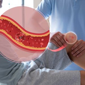 How Diabetes and Peripheral Vascular Disease are Interlinked