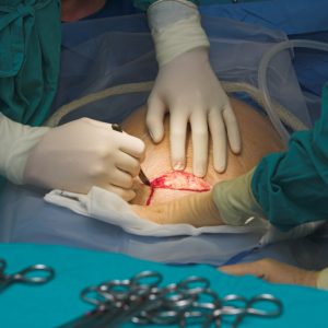 Healing After a C-Section: How to Care for Your Scar
