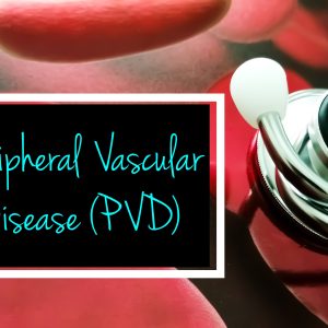 How to Improve Blood Circulation and Reduce the Risk of Peripheral Vascular Disease