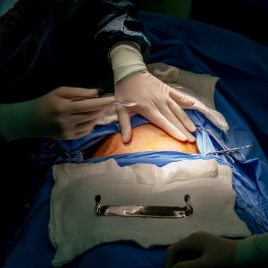 When is a C-Section Necessary? Reasons and Considerations